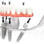 Новые зубы по технологии all-on-4